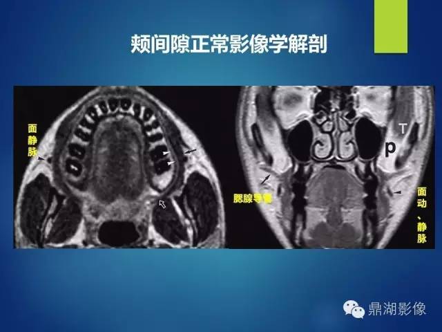 【PPT】颊间隙影像学解剖与病变的诊断
