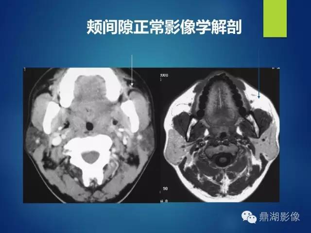 【PPT】颊间隙影像学解剖与病变的诊断