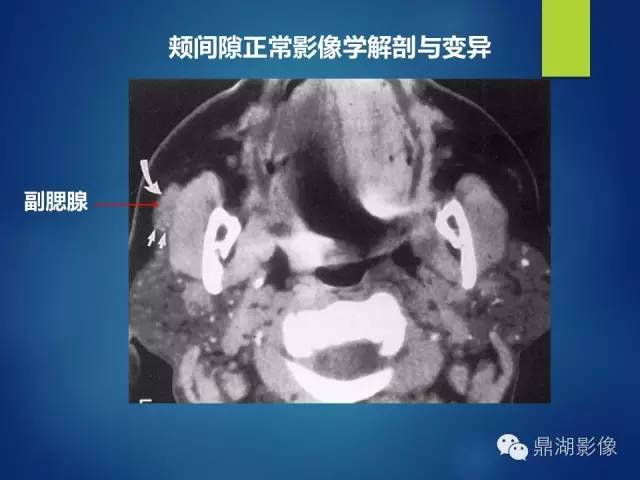 【PPT】颊间隙影像学解剖与病变的诊断