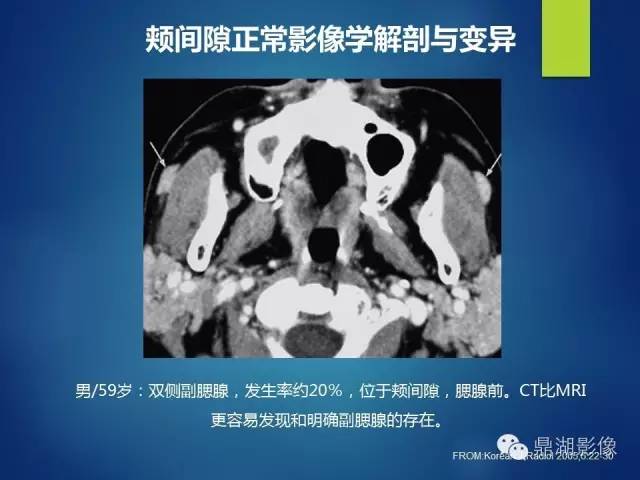 【PPT】颊间隙影像学解剖与病变的诊断