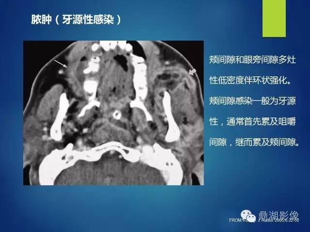 【PPT】颊间隙影像学解剖与病变的诊断