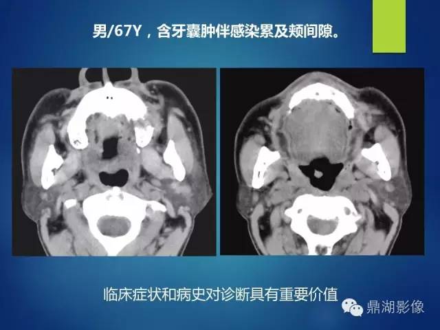 【PPT】颊间隙影像学解剖与病变的诊断