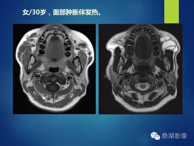 【PPT】颊间隙影像学解剖与病变的诊断