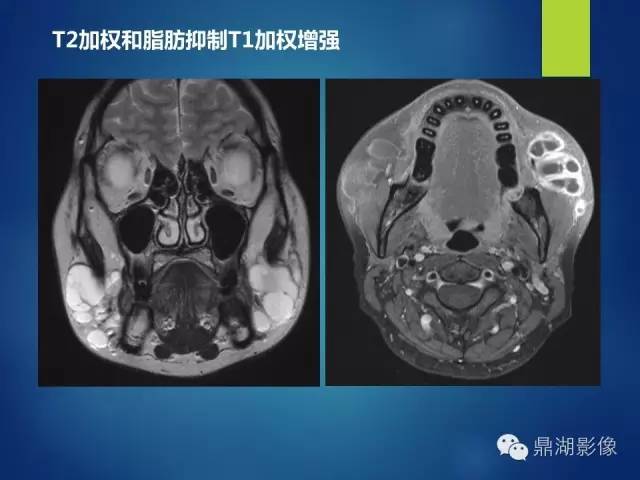 【PPT】颊间隙影像学解剖与病变的诊断