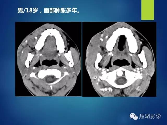 【PPT】颊间隙影像学解剖与病变的诊断