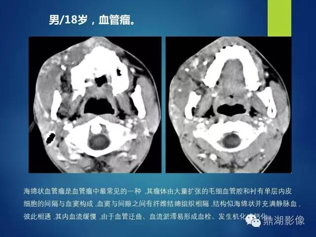 【PPT】颊间隙影像学解剖与病变的诊断