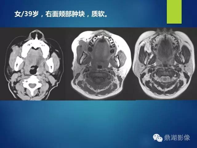 【PPT】颊间隙影像学解剖与病变的诊断