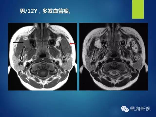 【PPT】颊间隙影像学解剖与病变的诊断