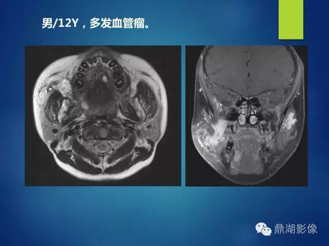 【PPT】颊间隙影像学解剖与病变的诊断