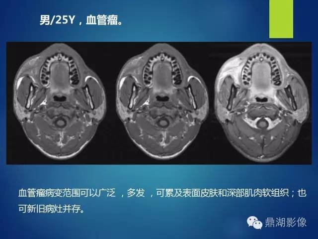 【PPT】颊间隙影像学解剖与病变的诊断