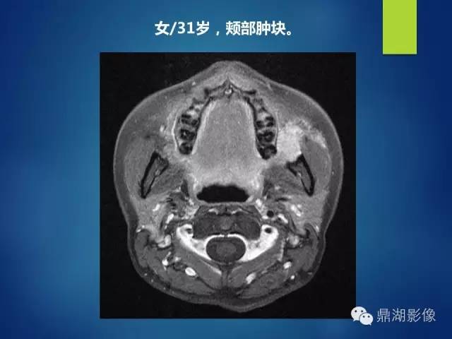 【PPT】颊间隙影像学解剖与病变的诊断