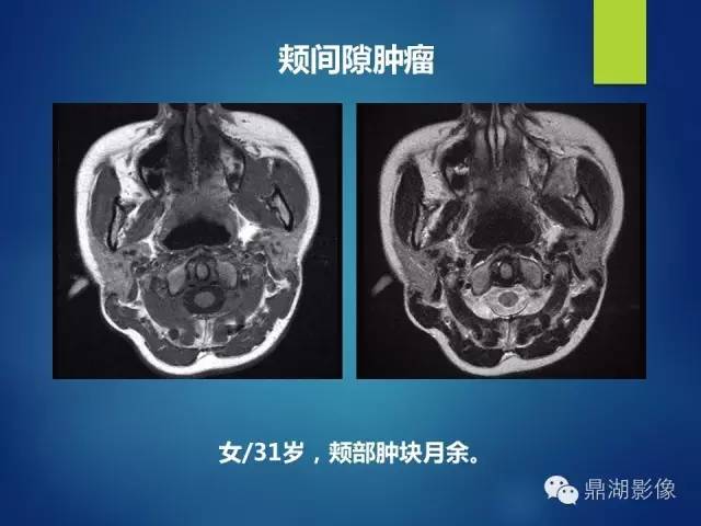 【PPT】颊间隙影像学解剖与病变的诊断
