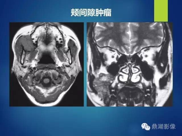 【PPT】颊间隙影像学解剖与病变的诊断
