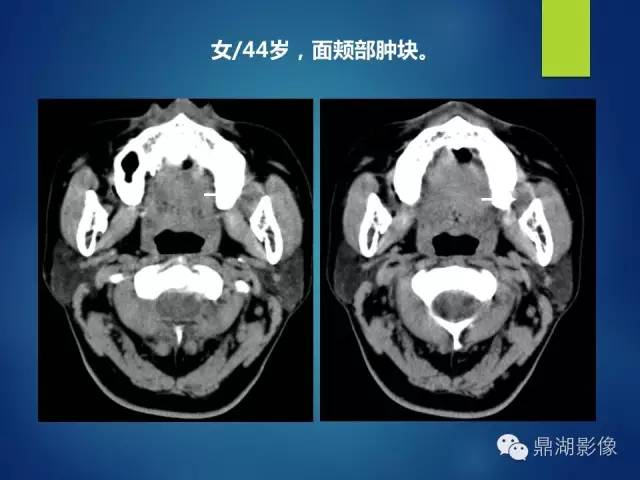 【PPT】颊间隙影像学解剖与病变的诊断