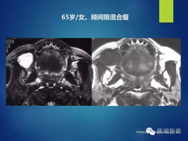 【PPT】颊间隙影像学解剖与病变的诊断
