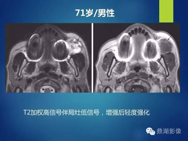 【PPT】颊间隙影像学解剖与病变的诊断