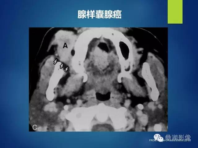 【PPT】颊间隙影像学解剖与病变的诊断