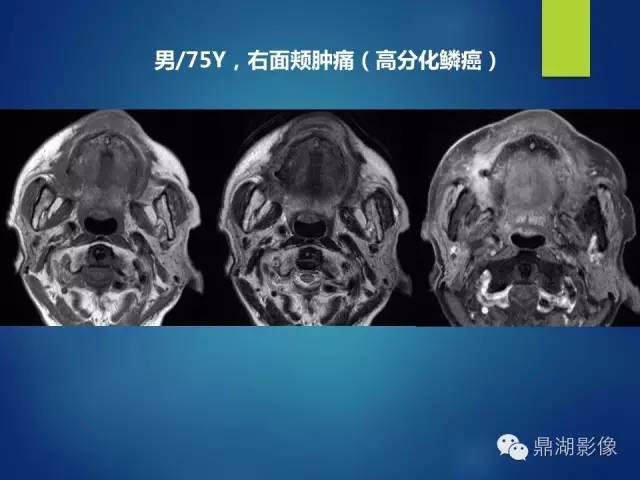 【PPT】颊间隙影像学解剖与病变的诊断