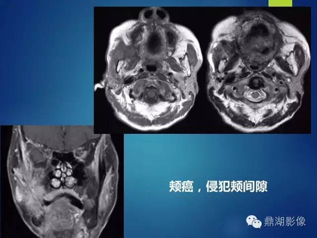 【PPT】颊间隙影像学解剖与病变的诊断