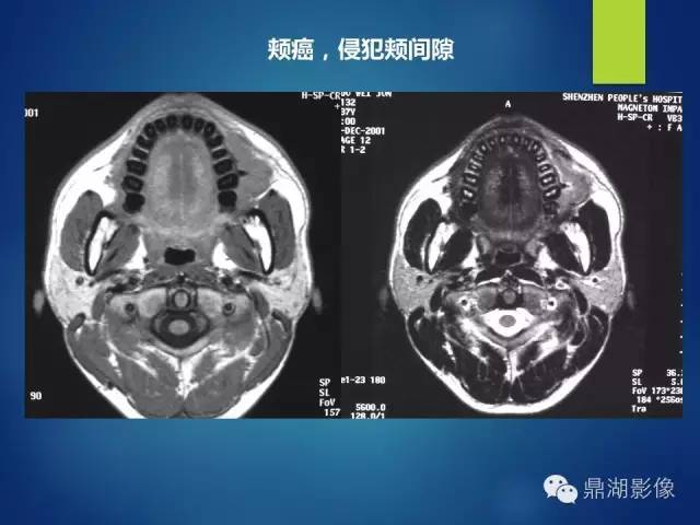 【PPT】颊间隙影像学解剖与病变的诊断