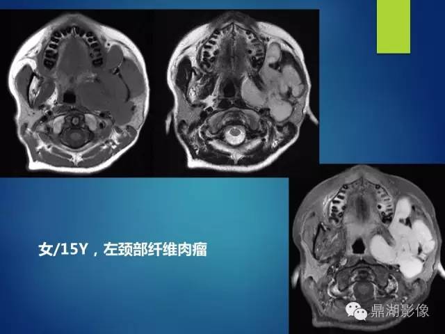 【PPT】颊间隙影像学解剖与病变的诊断