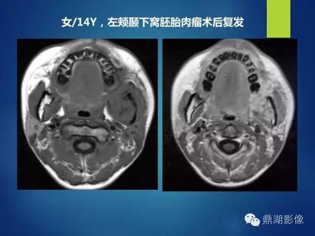 【PPT】颊间隙影像学解剖与病变的诊断
