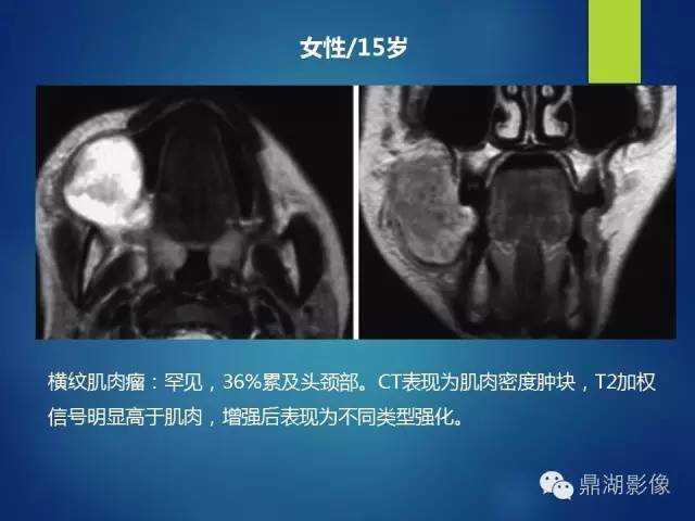 【PPT】颊间隙影像学解剖与病变的诊断
