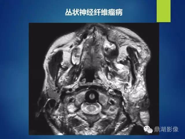【PPT】颊间隙影像学解剖与病变的诊断