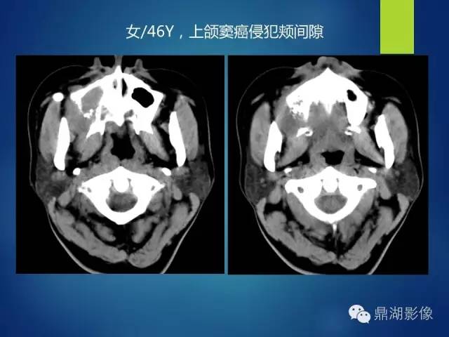 【PPT】颊间隙影像学解剖与病变的诊断