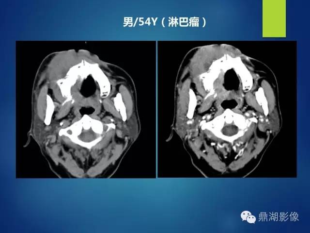 【PPT】颊间隙影像学解剖与病变的诊断