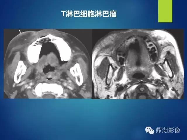 【PPT】颊间隙影像学解剖与病变的诊断