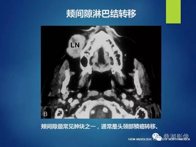 【PPT】颊间隙影像学解剖与病变的诊断