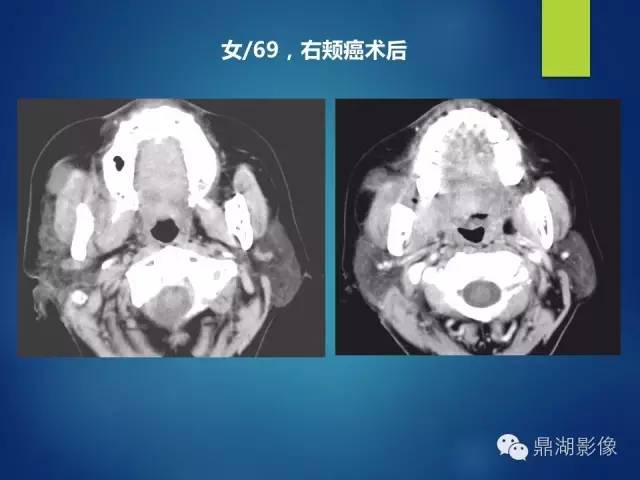 【PPT】颊间隙影像学解剖与病变的诊断