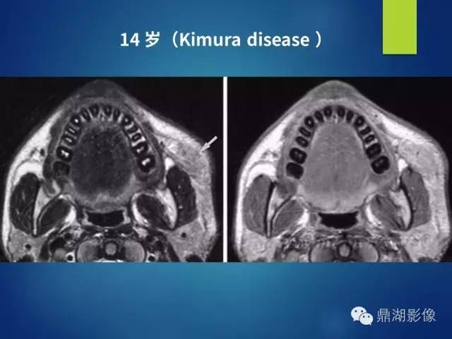【PPT】颊间隙影像学解剖与病变的诊断