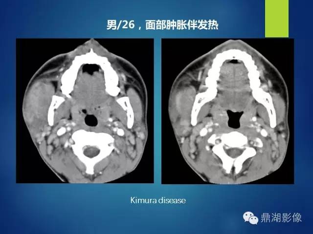 【PPT】颊间隙影像学解剖与病变的诊断
