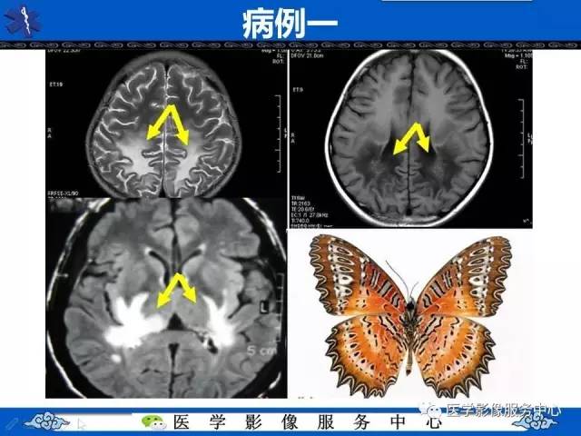 【影像征象】蝶翼征