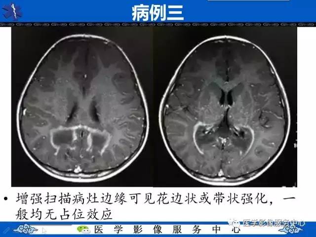 【影像征象】蝶翼征