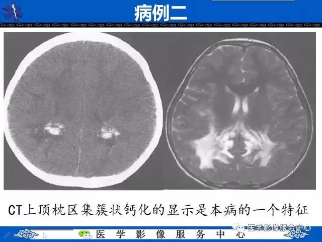 【影像征象】蝶翼征