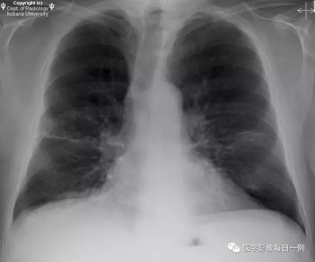 【病例】支气管扩张1例CT影像表现 【病例】支气管扩张1例CT影像表现