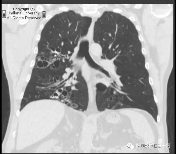 【病例】支气管扩张1例CT影像表现 【病例】支气管扩张1例CT影像表现