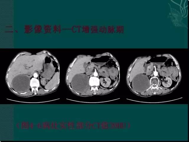 【病例】腹膜后神经鞘瘤1例CT及MR影像表现 【病例】腹膜后神经鞘瘤1例CT及MR影像表现