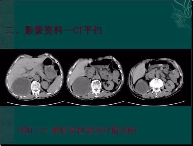 【病例】腹膜后神经鞘瘤1例CT及MR影像表现 【病例】腹膜后神经鞘瘤1例CT及MR影像表现