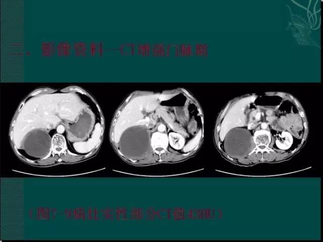 【病例】腹膜后神经鞘瘤1例CT及MR影像表现 【病例】腹膜后神经鞘瘤1例CT及MR影像表现
