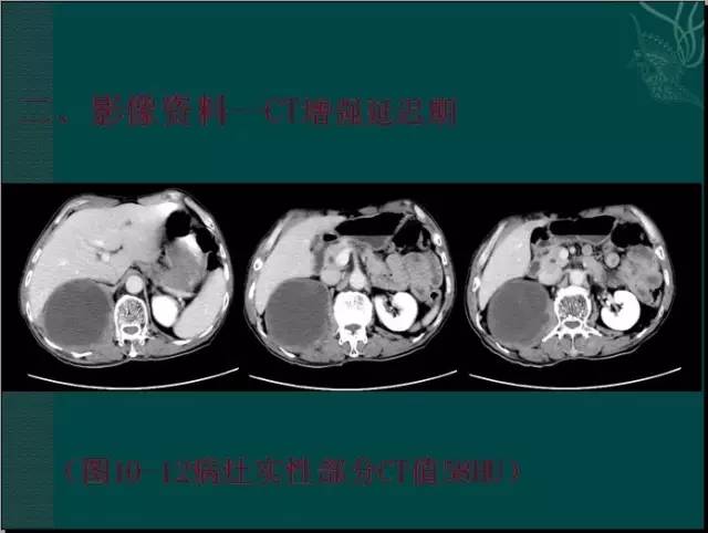 【病例】腹膜后神经鞘瘤1例CT及MR影像表现 【病例】腹膜后神经鞘瘤1例CT及MR影像表现