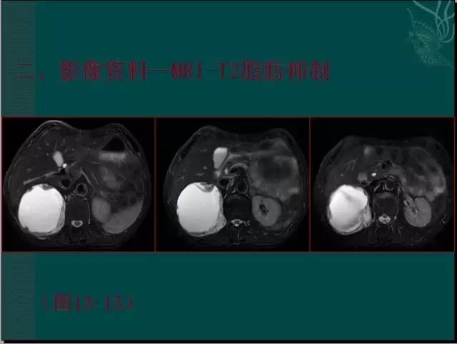 【病例】腹膜后神经鞘瘤1例CT及MR影像表现 【病例】腹膜后神经鞘瘤1例CT及MR影像表现