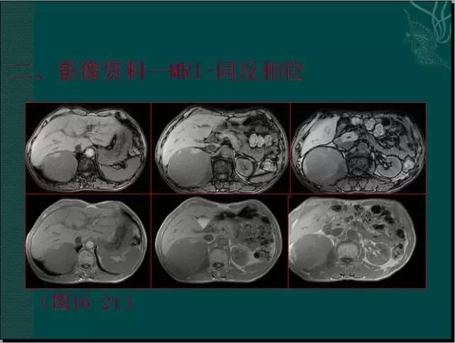 【病例】腹膜后神经鞘瘤1例CT及MR影像表现 【病例】腹膜后神经鞘瘤1例CT及MR影像表现