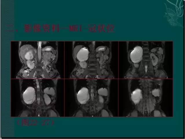 【病例】腹膜后神经鞘瘤1例CT及MR影像表现 【病例】腹膜后神经鞘瘤1例CT及MR影像表现