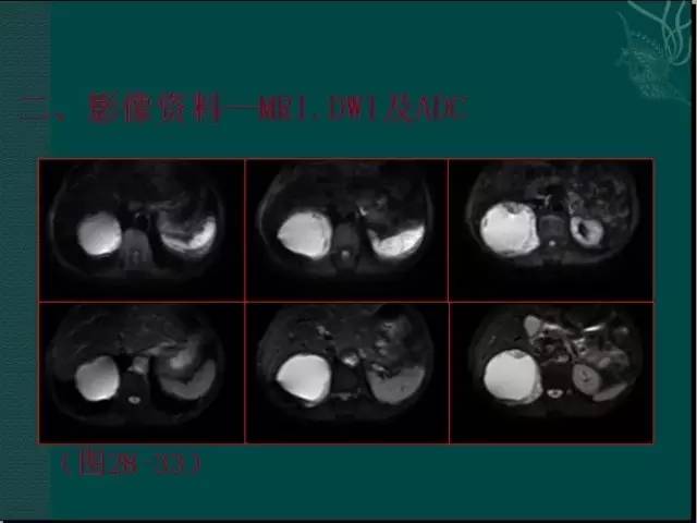 【病例】腹膜后神经鞘瘤1例CT及MR影像表现 【病例】腹膜后神经鞘瘤1例CT及MR影像表现