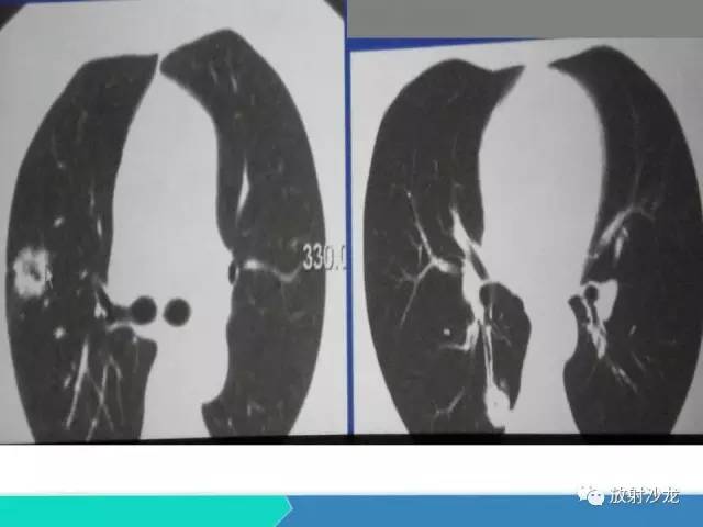 【PPT】浅谈周围型肺癌的CT诊断