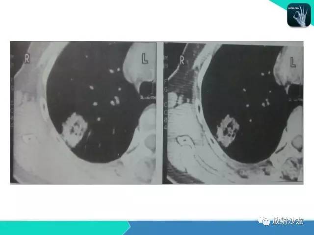 【PPT】浅谈周围型肺癌的CT诊断